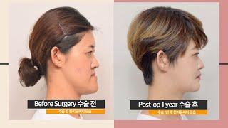 Prognathism (lantern jaw) corrected by double jaw surgery (surgery review)