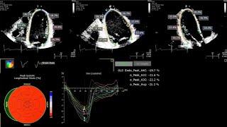 A Practical Guide to Echocardiographic Global Longitudinal Strain (GLS) by 2D Speckle Tracking