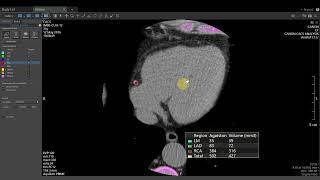 Vitrea Demonstrations  |  Cardiac Calcium Score