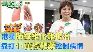 港星肺纖維化難根治 靠打11萬標靶藥控制病情 健康2.0