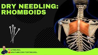 Dry Needling: Rhomboids