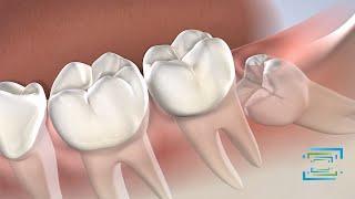 Wisdom Teeth Removal at Fresno Oral Maxillofacial Surgery & Dental Implant Center