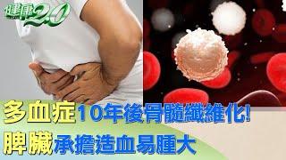 多血症10年後骨髓纖維化！ 脾臟承擔造血易腫大 健康2.0