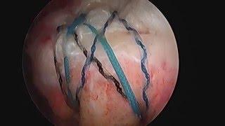 Rotator Cuff Tear and Arthroscopic Repair by Dr. Tony Moya