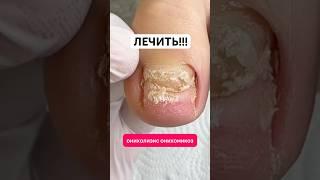 Эффективное средство от грибка ногтей. Артикул - 67774905