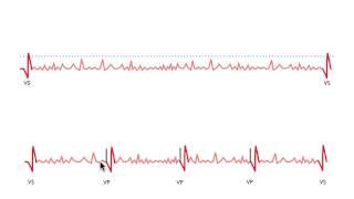 Pacemaker Issues Explained (Part 3): Navigating Oversensing