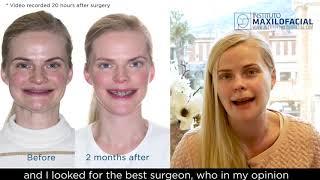 Double jaw surgery Case # 80: Katerina- Class 2, short face, mandibular hypoplasia