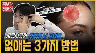 이마 트러블 필수시청 이마 트러블 없애는 방법 | 연세에이엔비피부과 이해진 원장