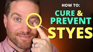 How To CURE And PREVENT STYES: Get Rid Of A Hordeolum (stye) And Chalazion Fast!