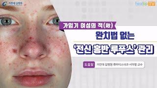 가임기 여성의 적(敵)완치법 없는 ‘전신 홍반 루푸스’ 관리