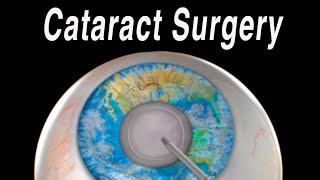 Cataract Eye Surgery Animation