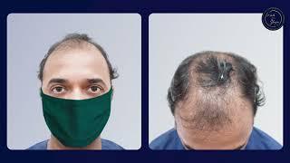 Hair Transplant in Mumbai | Best Results & Cost of Hair Transplant in Mumbai | Dr. Umang Kothari.