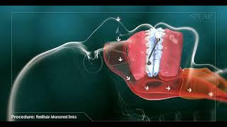 Mandibular Advancement Device