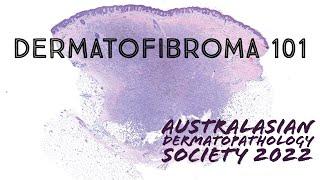 Dermatofibroma under the microscope (‪dermatology pathology dermpath USMLE)