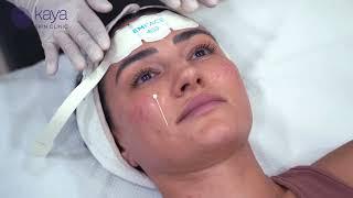 Reduce Sagging Skin and Wrinkles with EMFACE's Non-Invasive Treatment