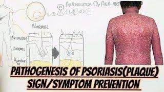 Psoriasis(plaque)