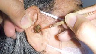 Removing Elderly Woman's Huge Earwax