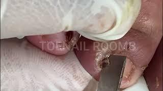 Toenail ASMR and Pedicure DIY Toenail ASMR and Pedicure DIY 479