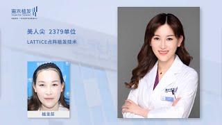 深圳雍禾植髮效果怎麼樣？雍禾護士都在給自己植髮！Yonghe hair transplant