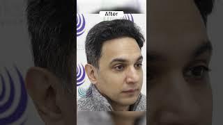 Best Hair Transplant in Delhi | Best Results of Hair Transplant #shortsfeed #shorts