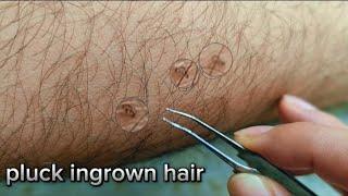 Part 111 Plucking ingrown hairs removal, نتف الشعر الناشئ, nhổ lông mọc ngược trên chân trc hè