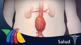 Aneurisma de aorta: padecimiento mortal | Salud