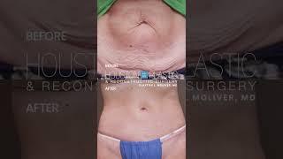 Tummy Tuck Journey: 3-Month Update on Scar Healing and Elasticity #tummytuck #abdominoplasty