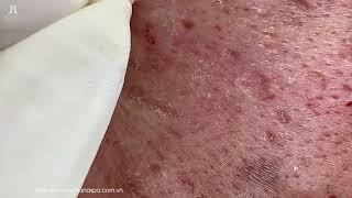 Big Cystic Acne Blackheads Extraction Blackheads & Milia, Whiteheads Removal Pimple Popping