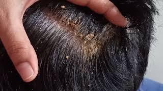 Scratching dandruff from hair