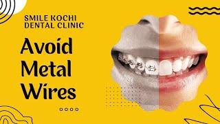 Metal-Free Transparent Aligners at Smile Kochi Dental Clinic | Kadavanthara | Palarivattom