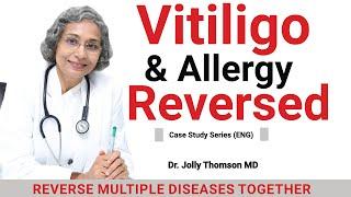 Vitiligo & Allergy-Reversed? 90 Days [Case Study] 18 Yrs Old