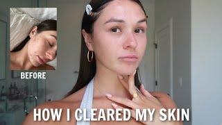 how I cleared my cystic acne + my daily skincare routine