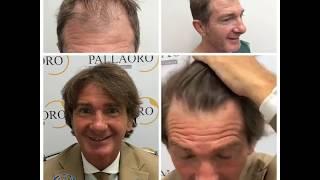 Trapianto capelli Micro FUE, risultato entusiasmante