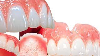 The Shocking Truth About Dentures: What You Need to Know!”