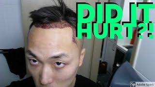 Did My Hair Transplant Hurt?!