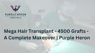 Mega Hair Transplant - 4500 Grafts - A Complete Makeover | Purple Heron