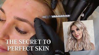 Prevent Acne with Baby Botox (ft. Madi Monroe)