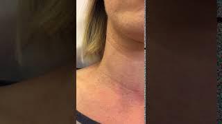 Jugular Vein Distention | MedBridge