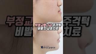 #주걱턱 수술 + 3급 부정교합 교정치료