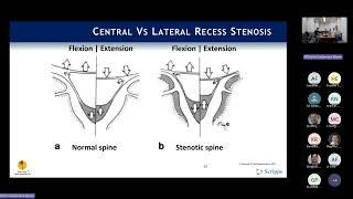 Indications: Neurogenic Claudication & Lateral Recess Stenosis : Phil Fagan, MD