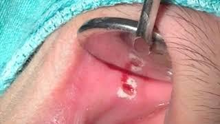 Er:YAG Laser Oral Ulcer Treatment