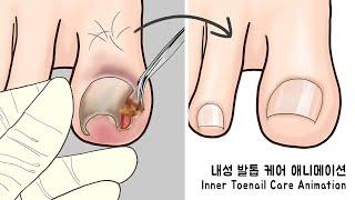 ASMR Coolness! Ingrown Toenail removal treatment animation