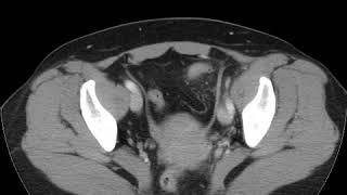 Diverticulitis (Ahuja AT et al; 2017) Book: Essential Radiology