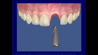 Одномоментная имплантация  в области переднего зуба
