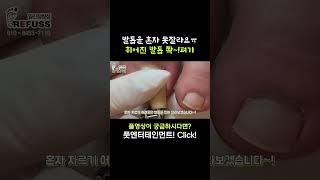 발톱을 혼자자르기 너무 어려웠던 고객님.. 내성발톱 끝판왕!! #레푸스 #일산레푸스 #내성발톱 #무좀발톱 #ingrown_toenail #일산내성발톱 #일산무좀발톱 #발톱