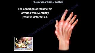 Rheumatoid Arthritis Of The Hand - Everything You Need To Know - Dr. Nabil Ebraheim