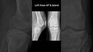 Serpiginous sclerotic medullary bone lesions are found around both knees #xray  #virlshorts