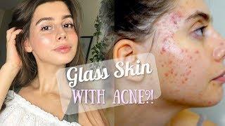 TRYING TO ACHIEVE GLASS SKIN WITH ACNE!! || Using Tarte, Physicians Formula, Morphe