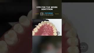 CPR for the Worn Dentition Sealing Lingual Margin | Dental Online Training #shorts