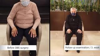 Change of Parkinson Patient Mrs. Fidan with DBS Treatment | Doç. Dr. Ali ZIRH